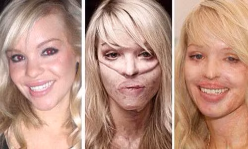 Gần đây trong xã hội hay xuất hiện hình thức tấn công người bằng cách tạt axit khiến nạn nhân, đa số là phụ nữ và trẻ em, bị bất ngờ, không né tránh kịp thời, dẫn đến bỏng nặng, thương tật vĩnh viễn và hủy hoại nhan sắc. Bởi vậy, việc xử lý thông minh nhất khi bị dính axit hay bỏng hóa chất trước khi được cấp cứu ở bệnh viện sẽ giảm đau đớn rất nhiều.