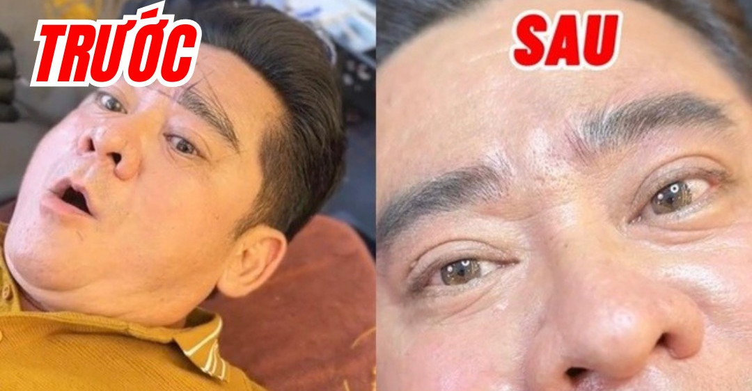 Sao nam gay bat ngo khi phau thuat tham my o tuoi trung nien