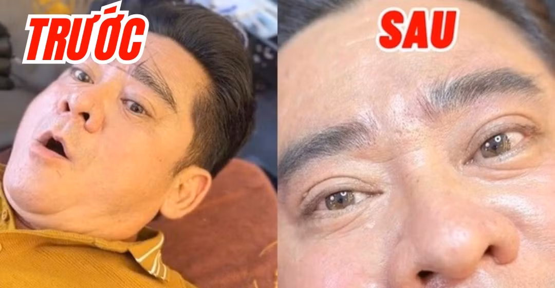 Sao nam gay bat ngo khi phau thuat tham my o tuoi trung nien