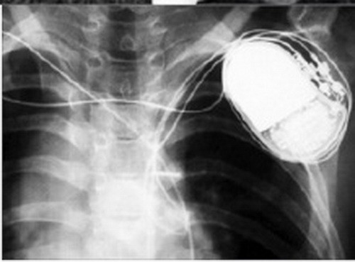 Lỗi thao tác này khiến nhà khoa học Greatbatch tạo ra các xung điện giống hệt nhịp đập của tim.