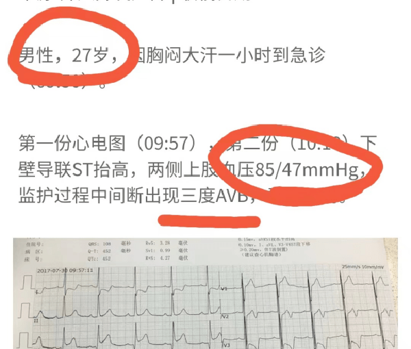 Trang Sohu (Trung Quốc) thông tin, một chàng trai bất ngờ bị nhồi máu cơ tim, đột tử khi mới 27 tuổi. Ban đầu, bệnh nhân lên cơn đau tức ngực nên người nhà đưa đến viện khám. Dù được bác sĩ điều trị tích cực song tình trạng đau tức ngực, khó thở, choáng, toàn thân đau đớn... ngày càng diễn biến xấu. Sau 20 tiếng vật lộn với cơn đau, chàng trai trút hơi thở cuối cùng trước sự ngỡ ngàng, đau đớn của người thân. (Ảnh: Sohu)