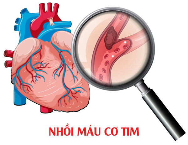 Thực tế, cơ thể thường phát ra dấu hiệu nhồi máu cơ tim song nhiều người phớt lờ. Chẳng hạn, trước khi nhồi máu cơ tim “ghé thăm”, cơ thể sẽ có những cơn đau thắt ngực. (Ảnh: Suckhoedoisong)