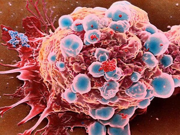 Nghiên cứu ở quy mô lớn, chuyên gia nhận thấy sự xáo trộn đồng hồ sinh học sẽ làm tăng nguy cơ mắc ung thư.