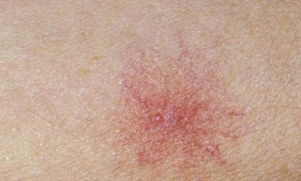 Để nhận biết dấu hiệu bệnh gan, chuyên gia khuyên nên chú ý những “chấm đỏ nhỏ” trên da. Chấm đỏ này còn được gọi là nốt ruồi nhện. Nó có hình dạng giống như mạng nhện, ở giữa là một chấm đỏ, xung quanh là những tia máu đỏ. Chấm đỏ thường xuất hiện trên mặt, cổ, ngực và lưng.