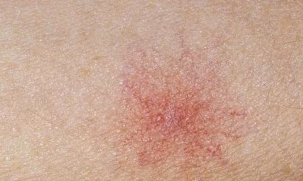 Để nhận biết dấu hiệu bệnh gan, chuyên gia khuyên nên chú ý những “chấm đỏ nhỏ” trên da. Chấm đỏ này còn được gọi là nốt ruồi nhện. Nó có hình dạng giống như mạng nhện, ở giữa là một chấm đỏ, xung quanh là những tia máu đỏ. Chấm đỏ thường xuất hiện trên mặt, cổ, ngực và lưng.