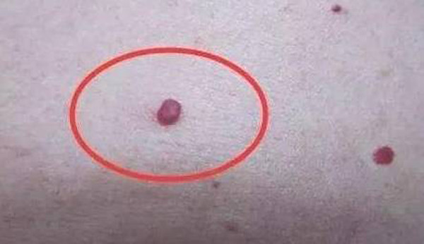 Ngoài ra, sự xuất hiện của nốt ruồi máu cũng báo hiệu gan có vấn đề. Bạn có thể nhận diện nốt ruồi máu thông qua hình dạng và màu sắc của chúng. Cụ thể, nốt ruồi máu có màu đỏ tươi, nổi gồ trên mặt da. Nốt ruồi máu có thể to bằng hạt đậu đỏ, ấn vào dễ vỡ và chảy máu. Chúng thường tập trung ở tay chân, bụng, ngực và lưng.