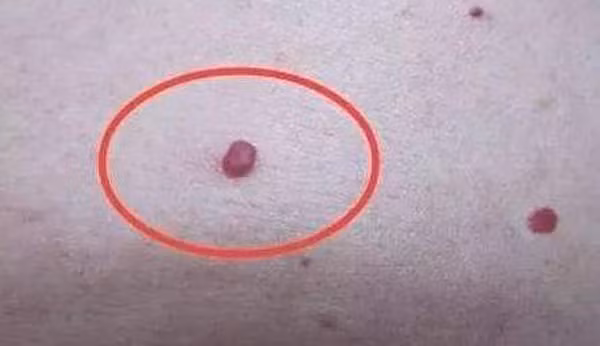 Ngoài ra, sự xuất hiện của nốt ruồi máu cũng báo hiệu gan có vấn đề. Bạn có thể nhận diện nốt ruồi máu thông qua hình dạng và màu sắc của chúng. Cụ thể, nốt ruồi máu có màu đỏ tươi, nổi gồ trên mặt da. Nốt ruồi máu có thể to bằng hạt đậu đỏ, ấn vào dễ vỡ và chảy máu. Chúng thường tập trung ở tay chân, bụng, ngực và lưng.