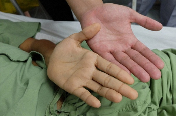 Chuyên gia cũng nhấn mạnh, nếu cơ thể xuất hiện những dấu hiệu như vàng da, lòng trắng của mắt chuyển vàng; khó ngủ, thức dậy sớm; khô mắt, mắt vằn vệt đỏ; da đen sạm, đốm, mọc nhiều mụn; mệt mỏi, chán ăn; hơi thở có mùi hôi; nước tiểu chuyển vàng đục; cơ thể nặng mùi... thì nên đi khám càng sớm càng tốt. Đây đều là dấu hiệu bệnh gan đang chuyển nặng.