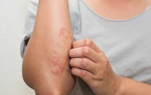 Nhiều người còn bị viêm da khi tiếp xúc với nấm mốc trong nhà. Ảnh: giaoducthoidai.