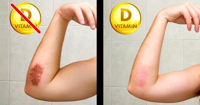6. Vết thương chậm phục hồi Một nghiên cứu đã chỉ ra rằng 12 tuần bổ sung vitamin D có thể làm giảm đáng kể vết thương ở những bệnh nhân bị loét chân do tiểu đường. Các nhà khoa học tin rằng vitamin D có tác động tích cực đến việc ổn định lượng đường trong máu và mức cholesterol của bệnh nhân.
