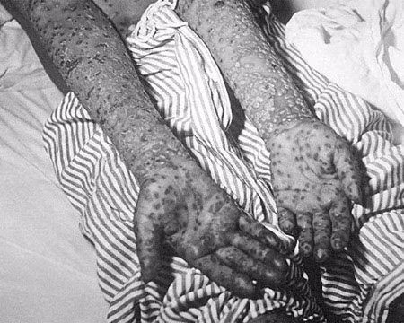 Vào khoảng thế kỷ thứ 10, các thầy lang Đạo giáo ở Trung Quốc đã nghĩ ra cách phòng bệnh đậu mùa vô cùng đặc biệt. Theo đó, các thầy lang đã lấy vẩy sẹo của người bị bệnh (chứa mầm bệnh), cho vào một chiếc hộp kín rồi giữ ở nhiệt độ nhất định trong một thời gian để giảm độc tính, sau đó nghiền nhỏ thổi vào mũi của người khỏe chưa từng mắc bệnh đậu mùa để phòng ngừa bệnh đậu mùa.