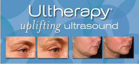 Trước và sau điều trị với công nghệ Ultherapy.