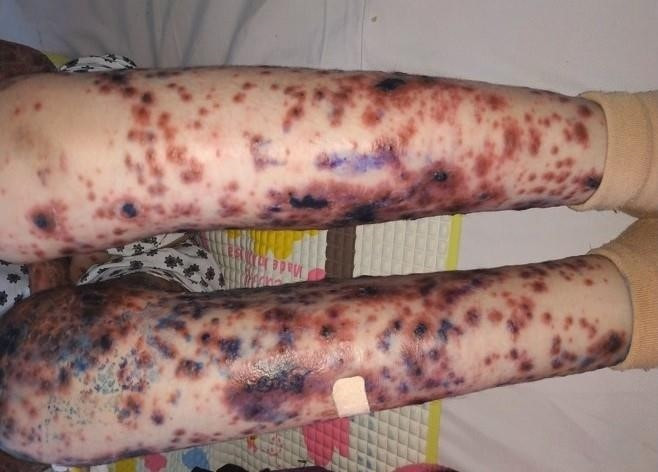 Be gai Viet mac benh cuc hiem kem loet hoai tu va sot cao