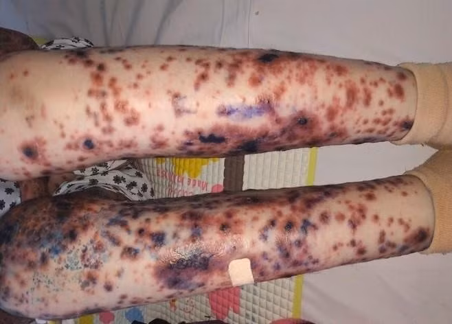 Be gai Viet mac benh cuc hiem kem loet hoai tu va sot cao