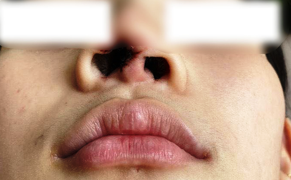 Phau thuat tham my o spa, thieu nu phai nao vet mui bien dang