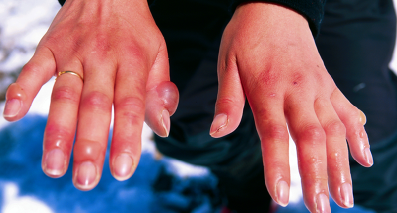 Xử lý vết thương do bỏng lạnh: Trong trường hợp bị tê cóng, bạn nên vào phòng ngay để cởi bỏ quần áo đã nhiễm lạnh và ướt ra khỏi vùng cơ thể bị ảnh hưởng. Ngâm phần cơ thể bị bỏng lạnh vào nước ấm (không chà xát) cho đến khi da trở nên mềm mại và cảm giác được phục hồi, sau đó nhanh chóng đến bệnh viện gần nhất.