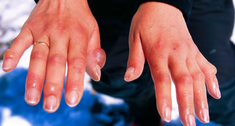 Xử lý vết thương do bỏng lạnh: Trong trường hợp bị tê cóng, bạn nên vào phòng ngay để cởi bỏ quần áo đã nhiễm lạnh và ướt ra khỏi vùng cơ thể bị ảnh hưởng. Ngâm phần cơ thể bị bỏng lạnh vào nước ấm (không chà xát) cho đến khi da trở nên mềm mại và cảm giác được phục hồi, sau đó nhanh chóng đến bệnh viện gần nhất.