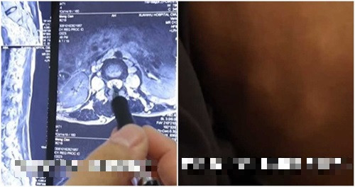 Mac benh hiem, co gai tre co hang nghin khoi u dau don-Hinh-2