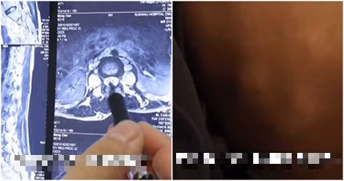 Mắc bệnh hiếm, cô gái trẻ có hàng nghìn khối u đau đớn - Hình 2 Mac benh hiem, co gai tre co hang nghin khoi u dau don-Hinh-2