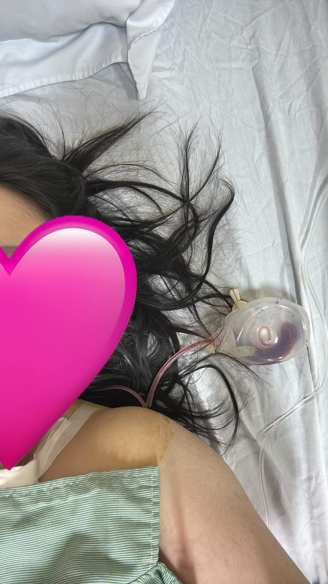 Đến hiện tại, sau nhiều lần truyền hóa chất, tuân theo phác đồ và sự chỉ dẫn của bác sỹ, khối u cũng đã biến mất. Tuy nhiên, cô bạn vẫn phải truyền hóa chất duy trì, 3 tuần một lần, trong vòng 1 năm.