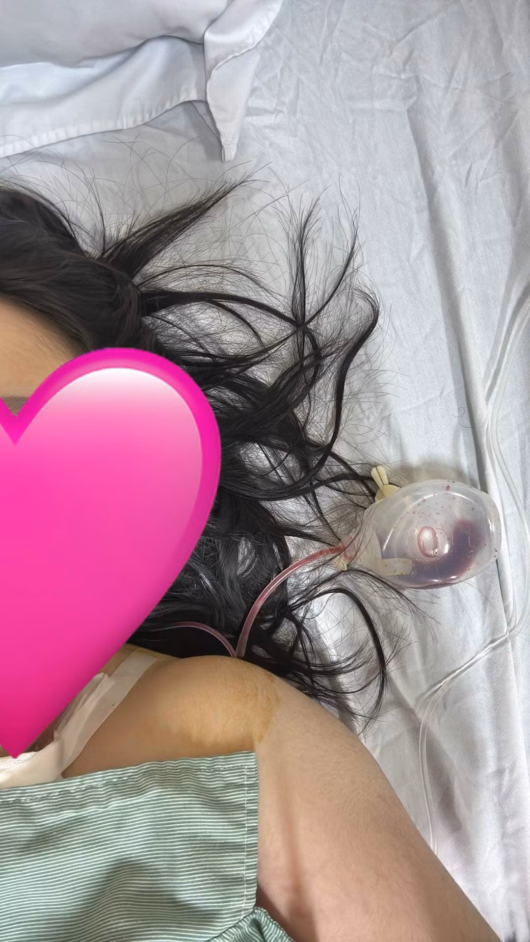 Đến hiện tại, sau nhiều lần truyền hóa chất, tuân theo phác đồ và sự chỉ dẫn của bác sỹ, khối u cũng đã biến mất. Tuy nhiên, cô bạn vẫn phải truyền hóa chất duy trì, 3 tuần một lần, trong vòng 1 năm.