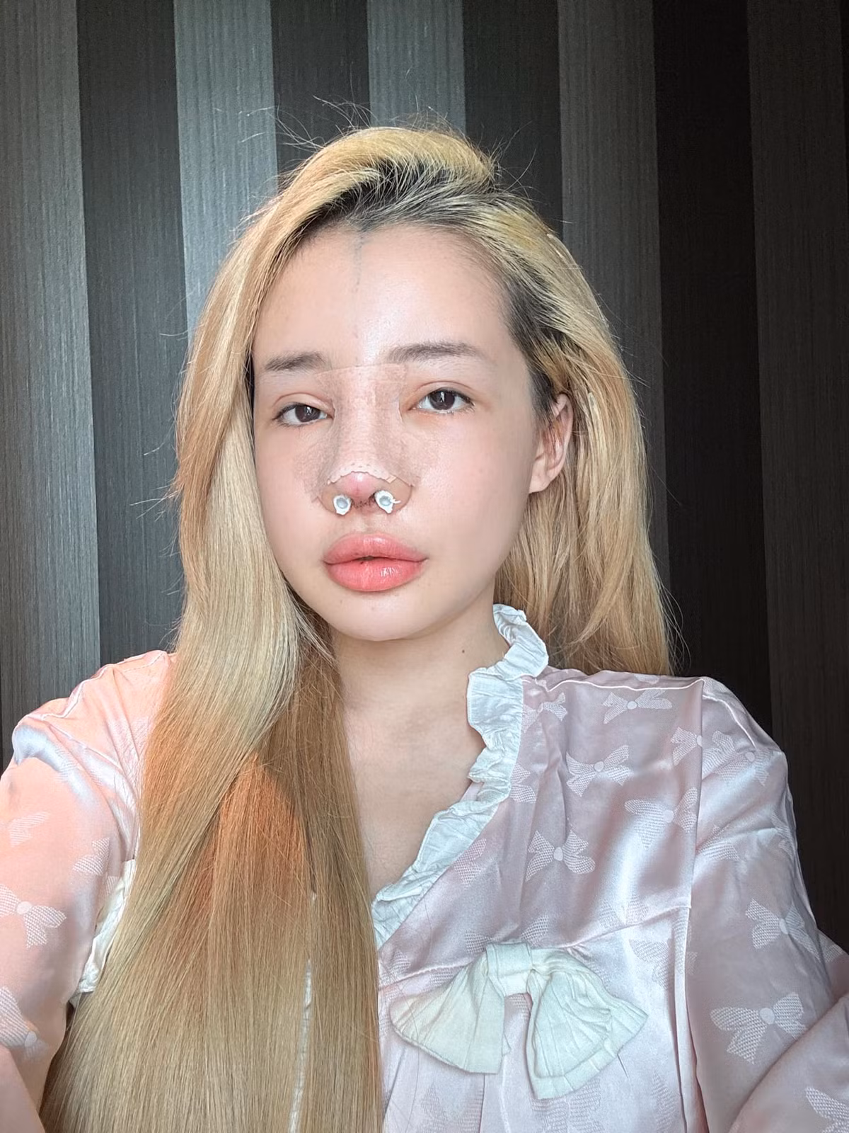 Cách đây ít lâu, Ngân 98 cập nhật hình ảnh sửa mũi.