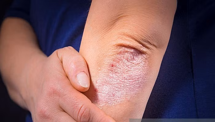 Tự chữa bệnh vảy nến, nhiều người nhận quả đắng - Hình 2 Tu chua benh vay nen, nhieu nguoi nhan qua dang-Hinh-2