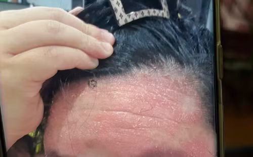 Tự chữa bệnh vảy nến, nhiều người nhận quả đắng Tu chua benh vay nen, nhieu nguoi nhan qua dang