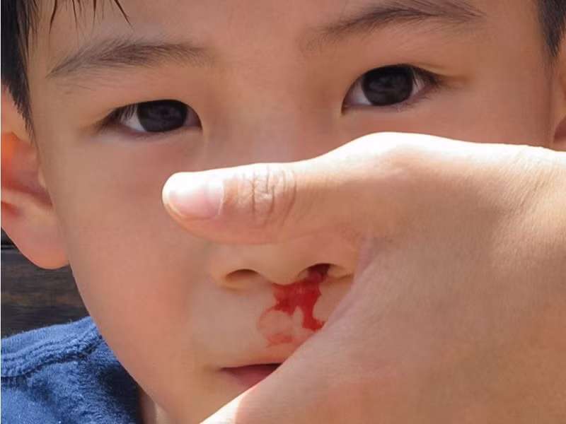 Mẹo làm ngừng chảy máu cam tại nhà hiệu quả Meo lam ngung chay mau cam tai nha hieu qua