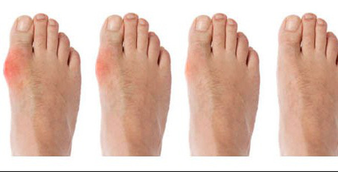 Benh gut an thit the nao de khong bi dau?