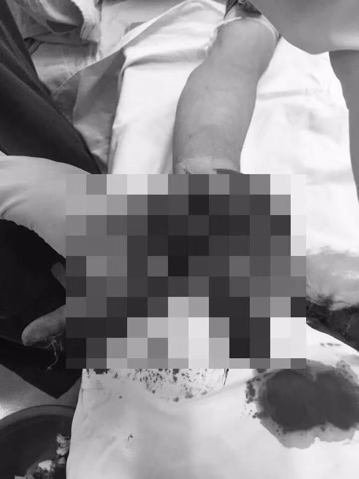 Thanh niên 19 tuổi phải cắt bỏ 3 ngón tay vì vừa sạc điện thoại vừa… chat: Ngày 11/2/2020 anh T.Q.V. (19 tuổi; huyện Thới Bình, Cà Mau) được người thân đưa vào bệnh viện với bàn tay dập nát. Anh V. được đưa vào bệnh viện xử lý vết thương, cấp cứu và cắt bỏ 3 ngón tay bị dập nát do điện thoại phát nổ. Nguyên nhân dẫn đến điện thoại anh V. phát nổ là khi anh đang vừa sạc pin vừa sử dụng. (Ảnh minh họa)