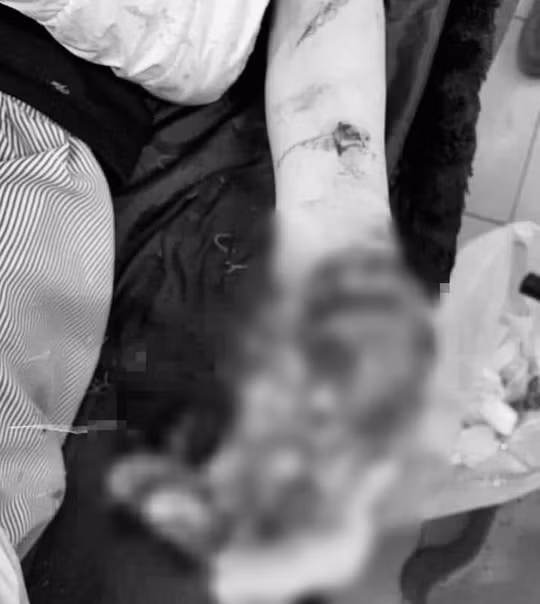 Điện thoại đang sạc phát nổ, thiếu niên dập nát 2 bàn tay: Ngày 19/12/2020, Phạm Đức L. (SN 2005, xã Nghĩa Lộ, Yên Bái) đã được gia đình đưa đi bệnh viện trong tình trạng bàn tay phải bị dập nát, mất hoàn toàn ngón 1, cụt đốt 2, 3 (ngón 2, 3) cụt ngón 4, 5; bàn tay trái nham nhở, dập nát phần mềm; gối phải bị thương chảy máu; vùng mặt, mắt tổn thương, cằm bị rách. Nguyên nhân L. nói là khi đang dùng điện thoại bỗng dưng phát nổ. (Ảnh Người lao động)