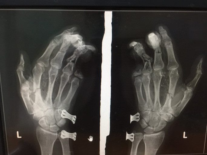  Điện thoại iPhone phát nổ, nam thanh niên dập nát bàn tay: Ngày 27/5/2020, Lương Thanh D. (37 tuổi, Biên Hòa, Đồng Nai) nhập viên trong tình trạng bàn tay trái dập nát và ngón út bị mất 2 đốt. Nguyên nhân là đang sử dụng điện thoại iPhone cắm dây sạc pin và chơi game thì điện thoại phát nổ. (Ảnh Người lao động)