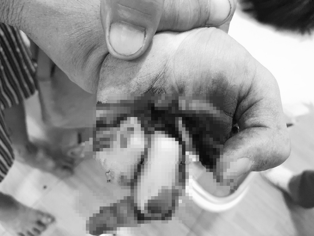  Vừa sạc pin vừa chơi game, một thiếu niên ở Bình Phước bị nổ nát bàn tay: Ngày 17/1/2021, em T.X.H (15 tuổi, huyện Bù Đăng, Bình Phước) đã được gia đình đưa đi cấp cứu trong tình trạng bàn tay bị dập nát. Nguyên nhân là em H. sạc pin điện thoại trong lúc đang chơi game, điện thoại bất ngờ phát nổ. ( Ảnh Thanh niên) 