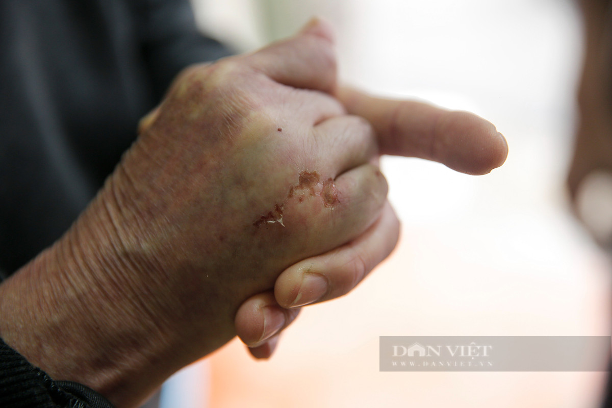 Ông Nguyễn Văn Minh (80 tuổi) sống tại phố Định Công Thượng vừa bị tai nạn giao thông bởi nắp cống ngay trước nhà mình khi đi xe vào lúc trời tối. 