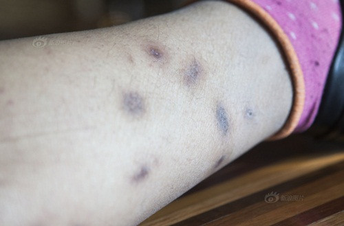 Mặc dù bị độc vật cưng của mình cắn cho hàng trăm lần, trong đó không thiếu những lần Gia Thạch suýt bỏ mạng nhưng anh vẫn không từ bỏ đam mê nguy hiểm này. Trong ảnh là chân trái của Gia Thạch với chi chít những vết cắn của độc vật mà anh nuôi.