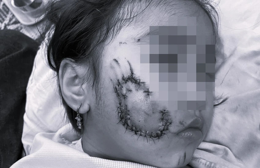 Bị chó cắn, bé gái 5 tuổi ở Quảng Bình phải khâu 50 mũi Bi cho can, be gai 5 tuoi o Quang Binh phai khau 50 mui