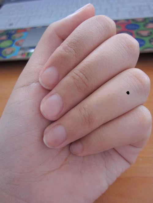 4. Nốt ruồi trên ngón vô danh (ngón áp út, ngón đeo nhẫn) Đốt thứ nhất có nốt ruồi: Bạn thuộc tuýp dễ bị kích động, vội vàng hấp tấp, làm việc thiếu nhiệt tình và tùy hứng. Vì thế bạn dễ bỏ dở giữa chừng, lại để chuyện tình cảm xen ngang vào công việc nên khó thành đại sự. Đốt giữa có nốt ruồi: Tài vận của bạn không tốt lắm, không thích hợp với những việc mang tính đầu cơ quá lớn. Có nốt ruồi này, bạn tuyệt đối tránh xa cờ bạc, những trò may rủi kẻo khuynh gia bại sản lúc nào không hay. Đốt thứ ba có nốt ruồi: Bạn quá coi trọng cái tôi, chúa ghét bị ràng buộc, xử lý công việc thì độc đoán, chuyên quyền, không hòa nhập với tập thể. Về tiền bạc, tiền tới rất nhanh, đi cũng rất nhanh vì thói quen tiêu tiền như nước.