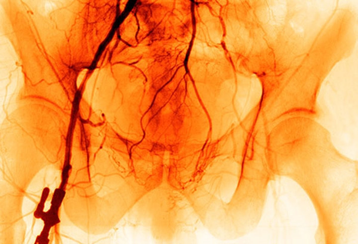 5. Bệnh động mạch ngoại biên: Bệnh này xảy ra khi những mảng xơ vữa làm hẹp động mạch, khiến chân và tay bạn khó có thể nhận đủ lượng máu cần thiết. Nếu một bên chân cảm thấy lạnh hơn rất nhiều so với bên còn lại, đặc biệt là cảm thấy tê, đau đớn, có thể là một triệu chứng của căn bệnh này