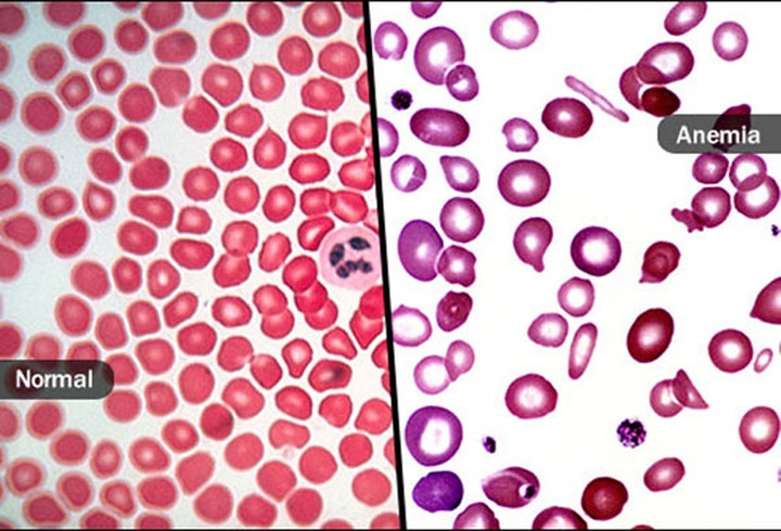 1.Thiếu máu: Thiếu máu có thể là một trong những nguyên nhân khiến bạn luôn có cảm giác ớn lạnh. Thiếu máu xảy ra khi cơ thể không có đủ lượng tế bào hồng cầu khỏe mạnh để vận chuyển oxy đi khắp cơ thể. Nó sẽ khiến bạn mệt mỏi, hoa mắt và khó thở. Thiếu máu cũng có thể khiến bạn luôn cảm thấy lạnh, đặc biệt là ở bàn chân và tay.