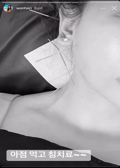 Khi đến Seoul (Hàn Quốc), nữ ca sĩ thực hiện trị liệu châm cứu chữa liệt cơ mặt. Ảnh: Vietnamnet