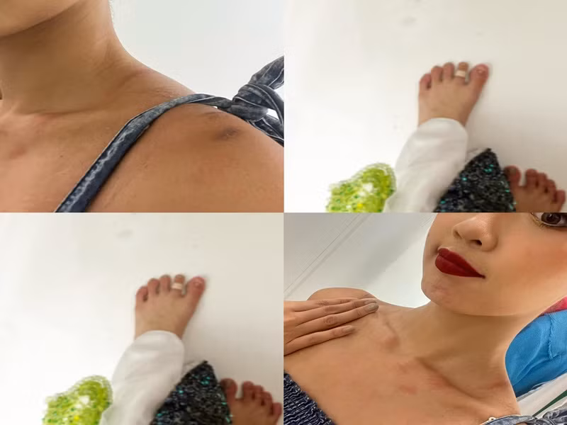 Người đẹp chia sẻ hình ảnh vai bị bầm do mặc trang phục khá nặng.