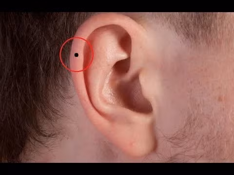  Nốt ruồi ở vành tai: Nốt ruồi ở vành tai tượng trưng cho tài vận vượng phát. Người có nốt ruồi ở vị trí này rất dễ dàng kiếm được tiền hơn nữa và cũng rất biết giữ tiền. Ngoài ra, vận quý nhân của họ cũng rất tốt, khi gặp khó khăn luôn có người tương trợ. Ảnh: youtube.com.