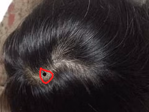 7 vi tri not ruoi may man troi ban cho dai tay xoa