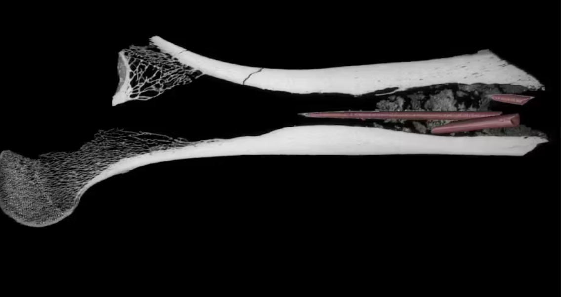 Trong cuộc thăm dò mới nhất, các chuyên gia phát hiện, ở mảnh xương đùi này có chứa ba đầu mũi tên nằm ngay trong khoang tủy. Ảnh: @Dr Aliénor Duhamel.