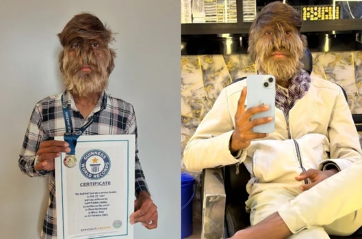 Lalit Patidar đã đạt được kỷ lục này, sau khi mắc phải tình trạng mọc lông hiếm gặp có tên là hypertrichosis, còn được gọi là "hội chứng người sói". Ảnh: @guinnessworldrecords.