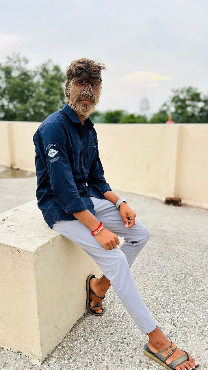 Người ta tin rằng, tình trạng này chỉ xảy ra ở 1 trong 1 tỷ người, với chỉ khoảng 50 trường hợp được ghi nhận kể từ thời Trung cổ. Ảnh: @guinnessworldrecords.