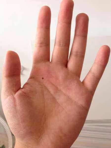 Nốt ruồi trong lòng bàn tay: Người đàn ông có nốt ruồi ở lòng bàn tay thường là người thông minh và không bao giờ phải lo lắng về tiền bạc. Ảnh:tieba.baidu.com 