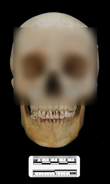 Tuy nhiên, đây là trường hợp đầu tiên được xác định về việc người xưa sử dụng chu sa nhuộm trên răng, không giống như các trường hợp khác sử dụng bột chu sa này trong hình xăm hoặc vẽ mặt. Ảnh: @Qian Wang.