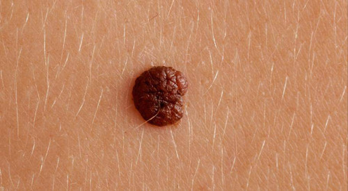 1. Nốt ruồi. Nốt ruồi là khối u da lành tính phổ biến, thường xuất hiện ở mặt, cổ, lưng,... Hầu hết nốt ruồi ít phát triển, đôi khi tồn tại nhiều năm không thay đổi.